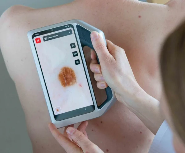 SKEEN – Advanced Imaging for Trichoscopy and Skin Lesion Assessment - Image 3