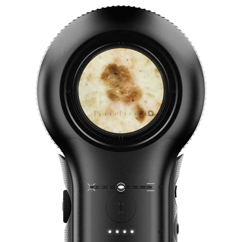 DermLite DL5 - Image 5